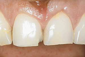Zähne ohne Veneer
